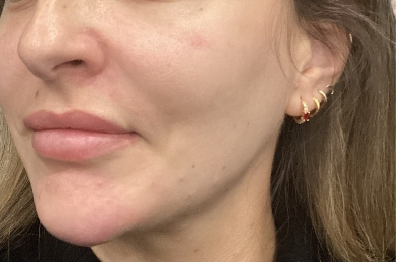 After - Chin Filler - Chin & jawline definition