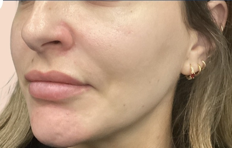 Before - Chin Filler - Chin & jawline definition