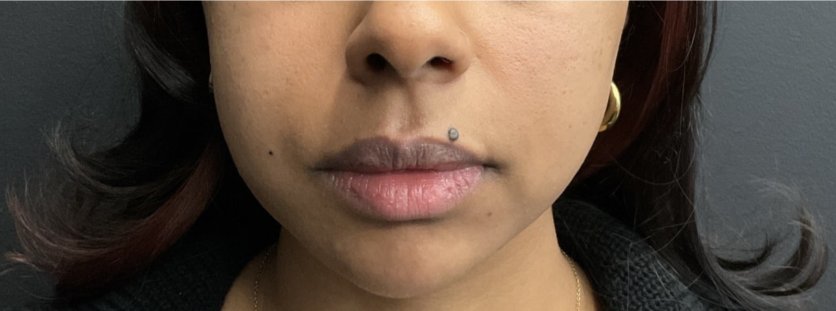 After - Chin Filler - Profile balancing - front view