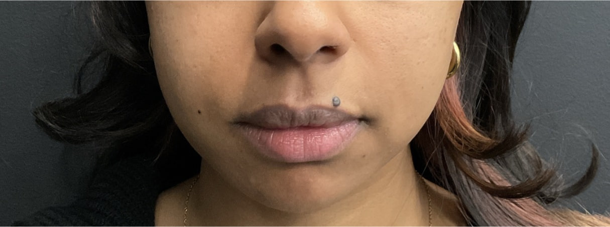 Before - Chin Filler - Profile balancing - front view