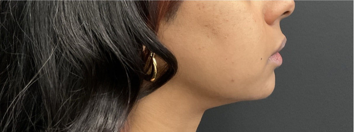 After - Chin Filler - Profile balancing - side view
