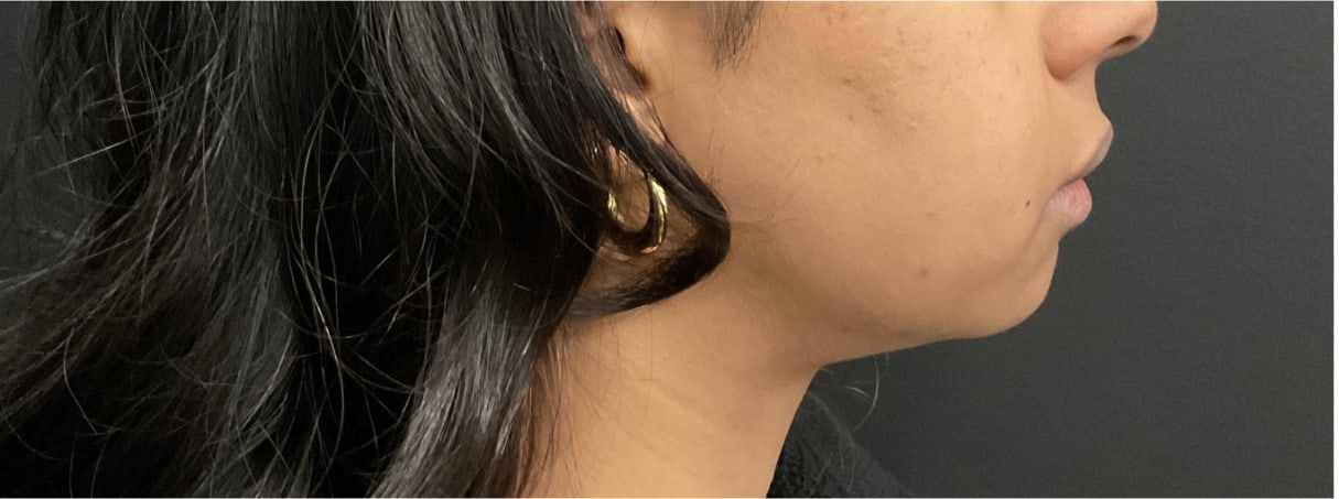 Before - Chin Filler - Profile balancing - side view