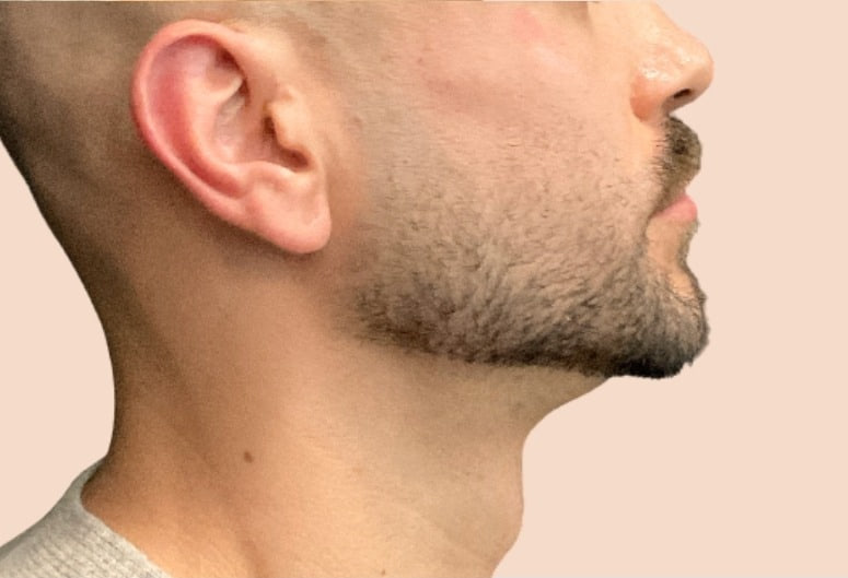 After - Chin Filler - Jawline & neck profile