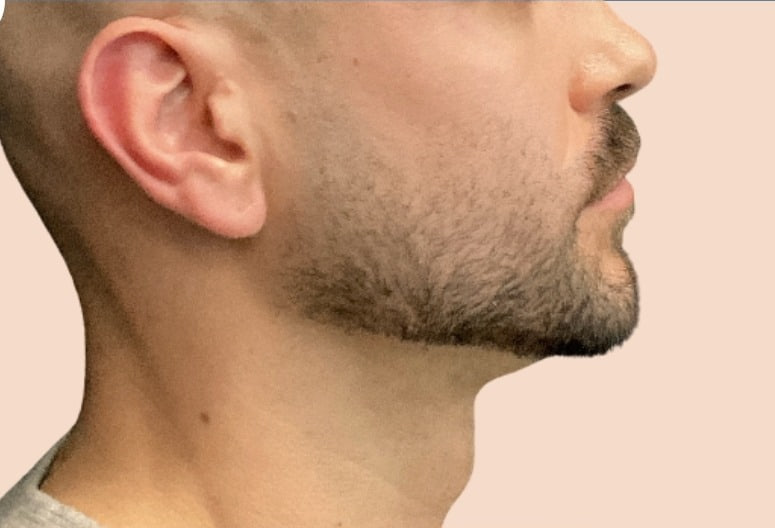 Before - Chin Filler - Jawline & neck profile