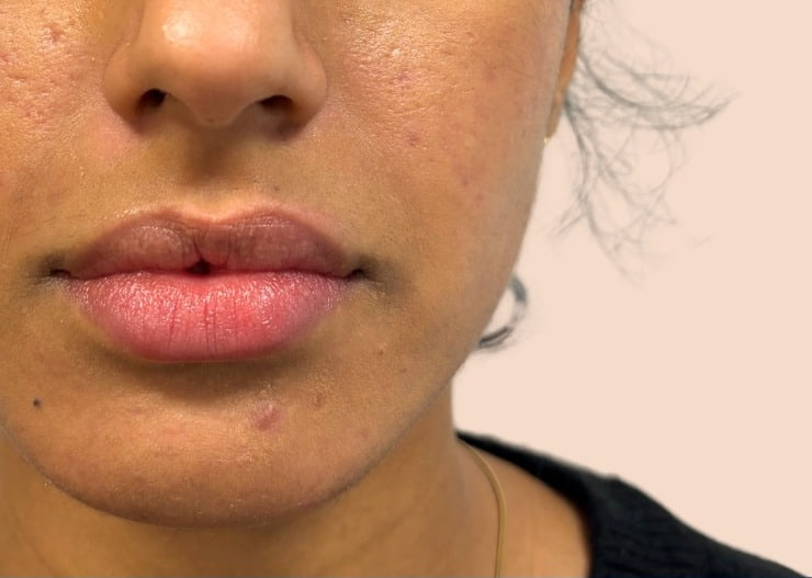 After - Lip Filler - Lip definition & volume