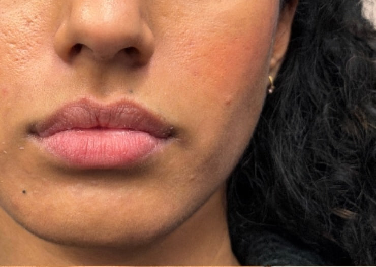 Before - Lip Filler - Lip definition & volume