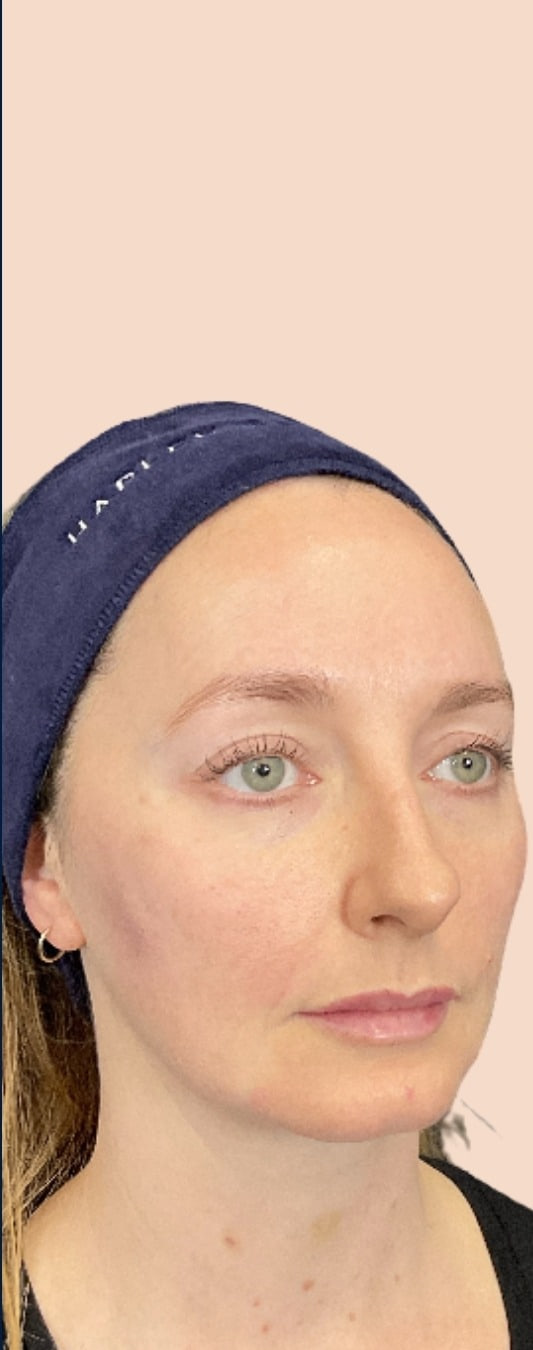 After - Multi-Area Dermal Treatment - Multi-area facial balancing