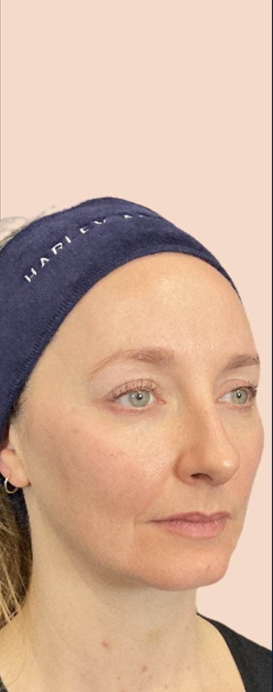 Before - Multi-Area Dermal Treatment - Multi-area facial balancing