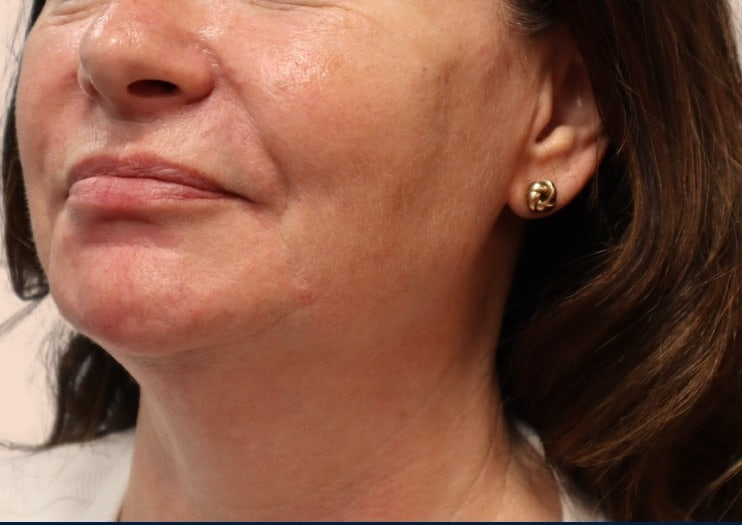 After - Nasolabial Folds - Nasolabial fold softening