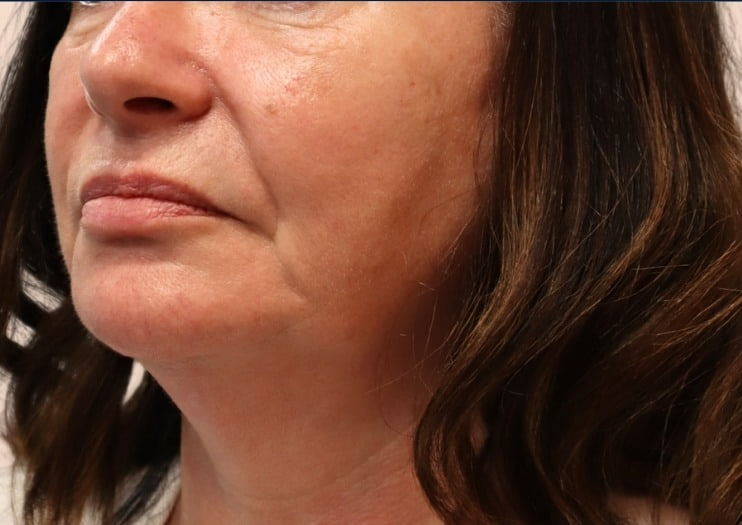 Before - Nasolabial Folds - Nasolabial fold softening