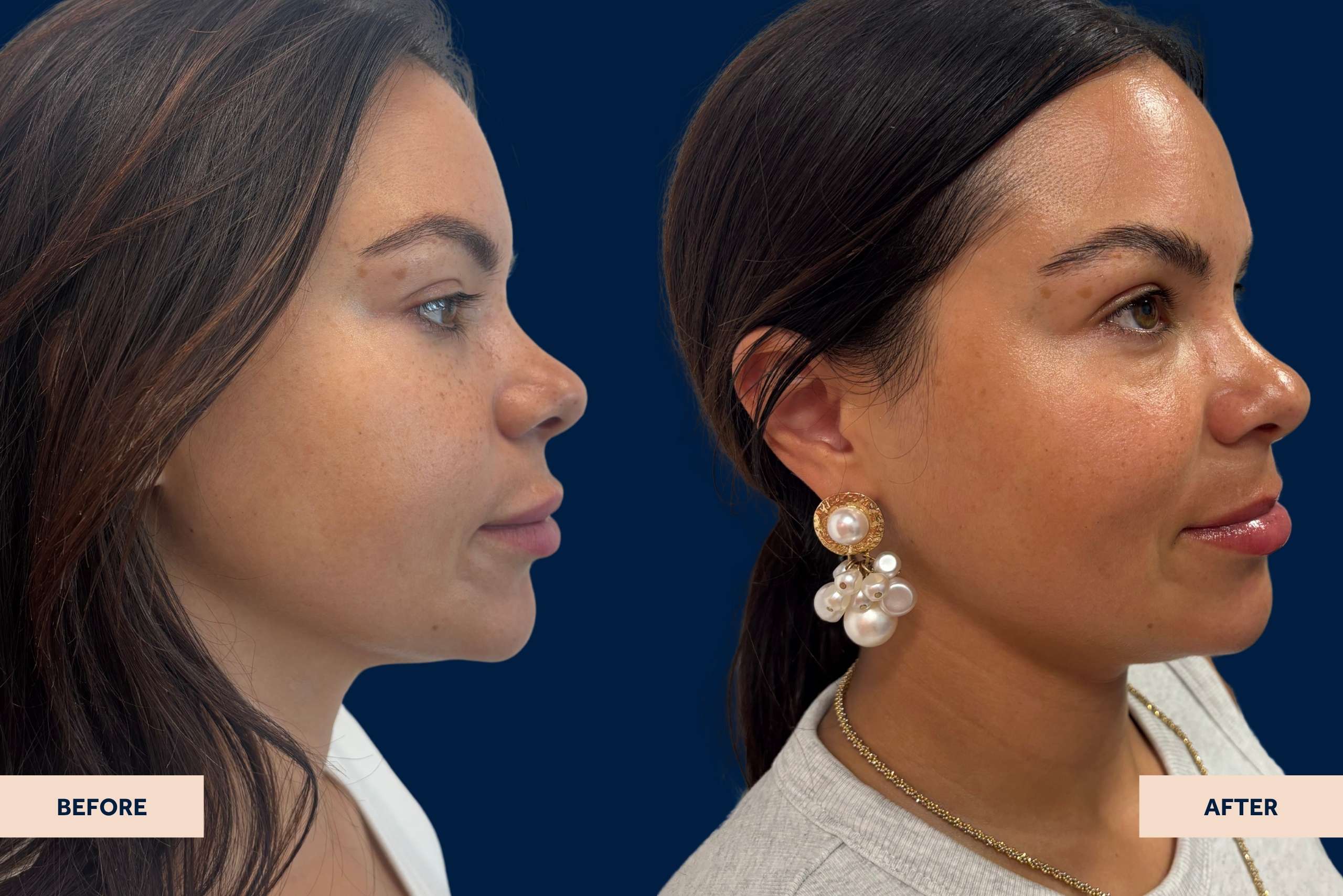 Patient dissolved lip filler before & after