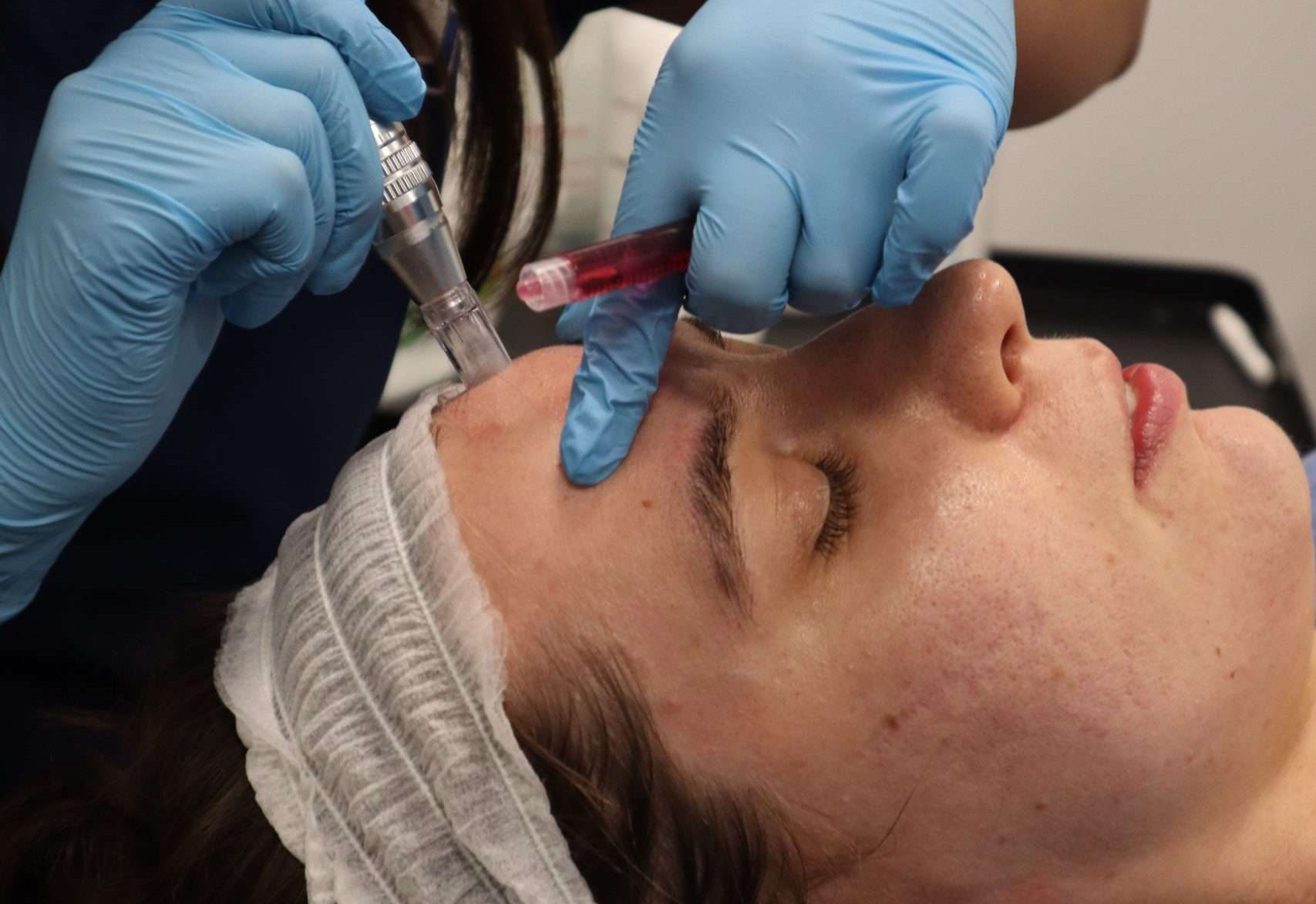Microneedling with Exosomes:The Next Generation of Skin Rejuvenation
