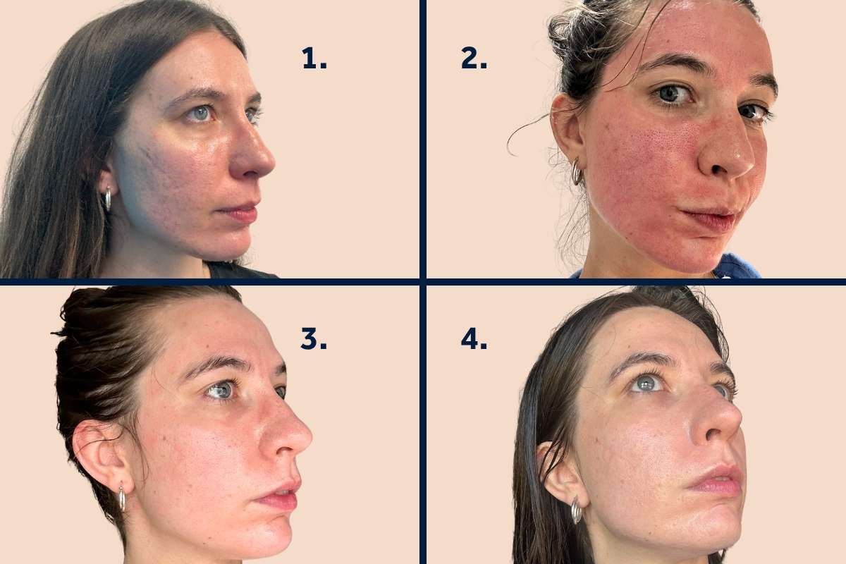 Microneedling with Exosomes Blog at The Academy Clinic Microneedling with Exosomes Blog at The Academy Clinic