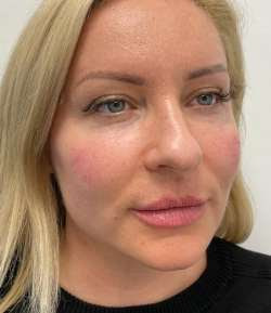 After - Cheek Filler - Cheek Filler result 1