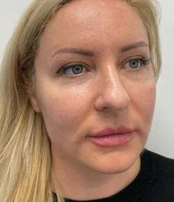Before - Cheek Filler - Cheek Filler result 1
