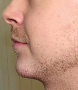 After - Chin Filler - Chin Filler result 2