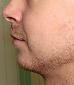 Before - Chin Filler - Chin Filler result 2