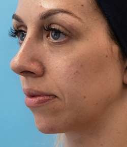 After - Chin Filler - Chin Filler result 1