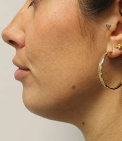 Before - Chin Filler - Chin Filler result 3