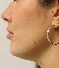 After - Chin Filler - Chin Filler result 3