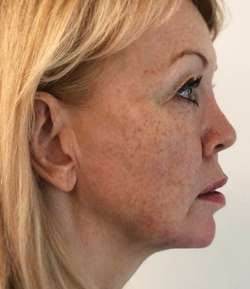After - Jaw Filler - Jaw Filler result 1