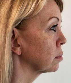 Before - Jaw Filler - Jaw Filler result 1