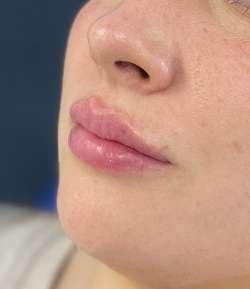 After - Lip Filler - Lip Filler result 2