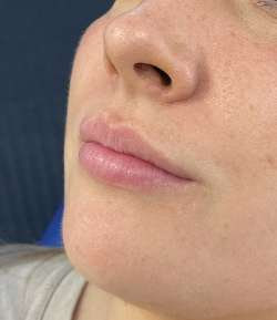 Before - Lip Filler - Lip Filler result 2