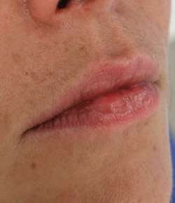 Before - Lip Filler - Lip Filler result 1