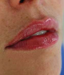 After - Lip Filler - Lip Filler result 1