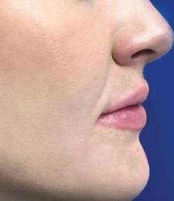 After - Lip Filler - Lip Filler result 3