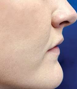 Before - Lip Filler - Lip Filler result 3