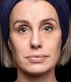 Before - Multi-Area Dermal Treatment - Multi-Area Dermal Treatment result 1
