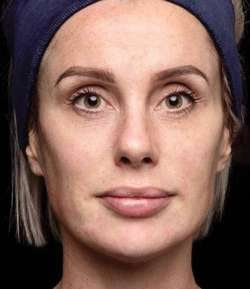 After - Multi-Area Dermal Treatment - Multi-Area Dermal Treatment result 1
