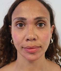 After - Multi-Area Dermal Treatment - Multi-Area Dermal Treatment result 3