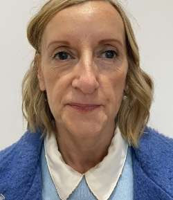 Before - Multi-Area Dermal Treatment - Multi-Area Dermal Treatment result 2