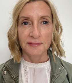 After - Multi-Area Dermal Treatment - Multi-Area Dermal Treatment result 2