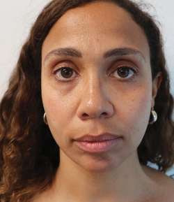 Before - Multi-Area Dermal Treatment - Multi-Area Dermal Treatment result 3