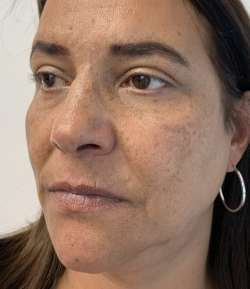 Before - Nasolabial Folds - Nasolabial Folds result 1
