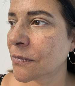After - Nasolabial Folds - Nasolabial Folds result 1